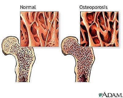 Osteoporos (benskörhet)