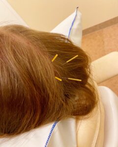 akupunktur huvudet